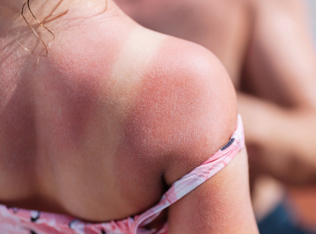 Sunburn Super Heros